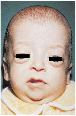 8246 9 36 infant exophthalmos