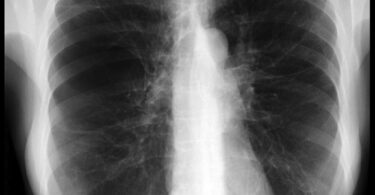 Alpha 1 antitrypsin deficiency 002