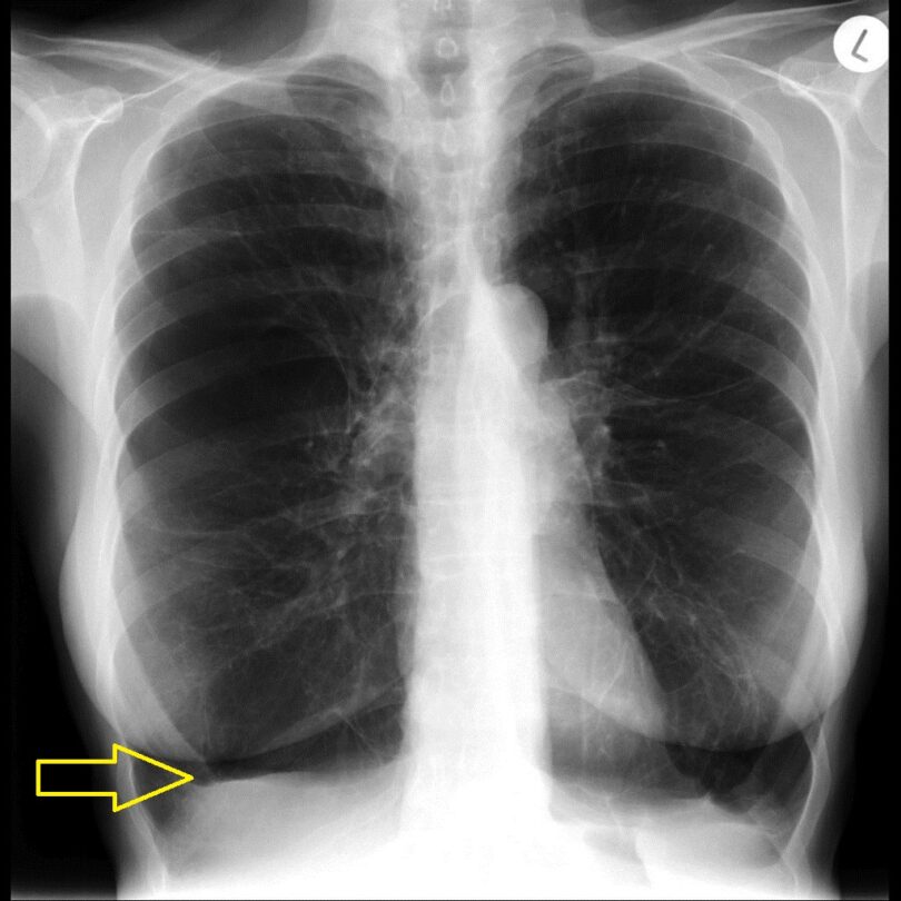 Alpha 1 antitrypsin deficiency 002