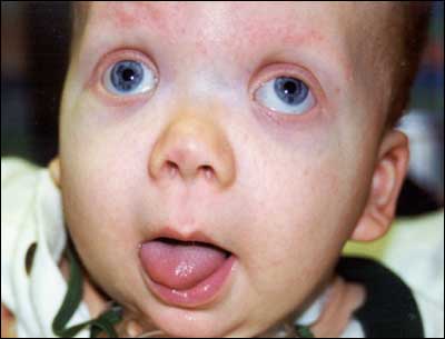 Beckwith Wiedemann Syndrome Image