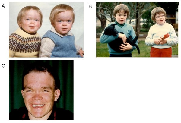 Facial features in alpha mannosidosis A Twins aged 18 Months Note enlarged head short