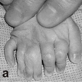 a and b Bilateral mesoaxial polysyndactyly in oro facial digital syndrome Q320