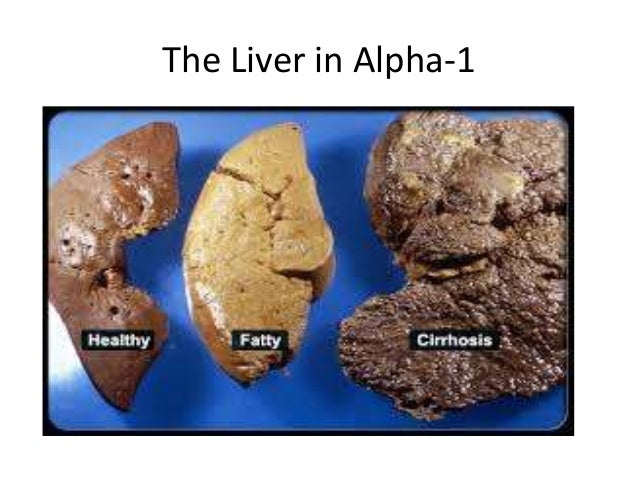 alpha 1 antitrypsin deficiency 36 638