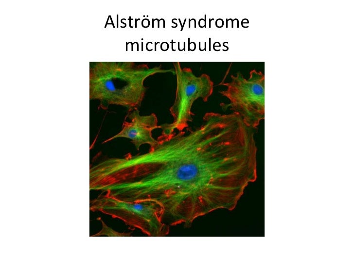 alstrm syndrome 12 728