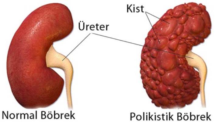 polikistik bobrek hastaligi